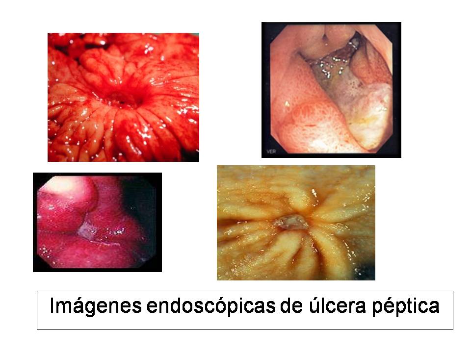 Cuidados de la gastritis